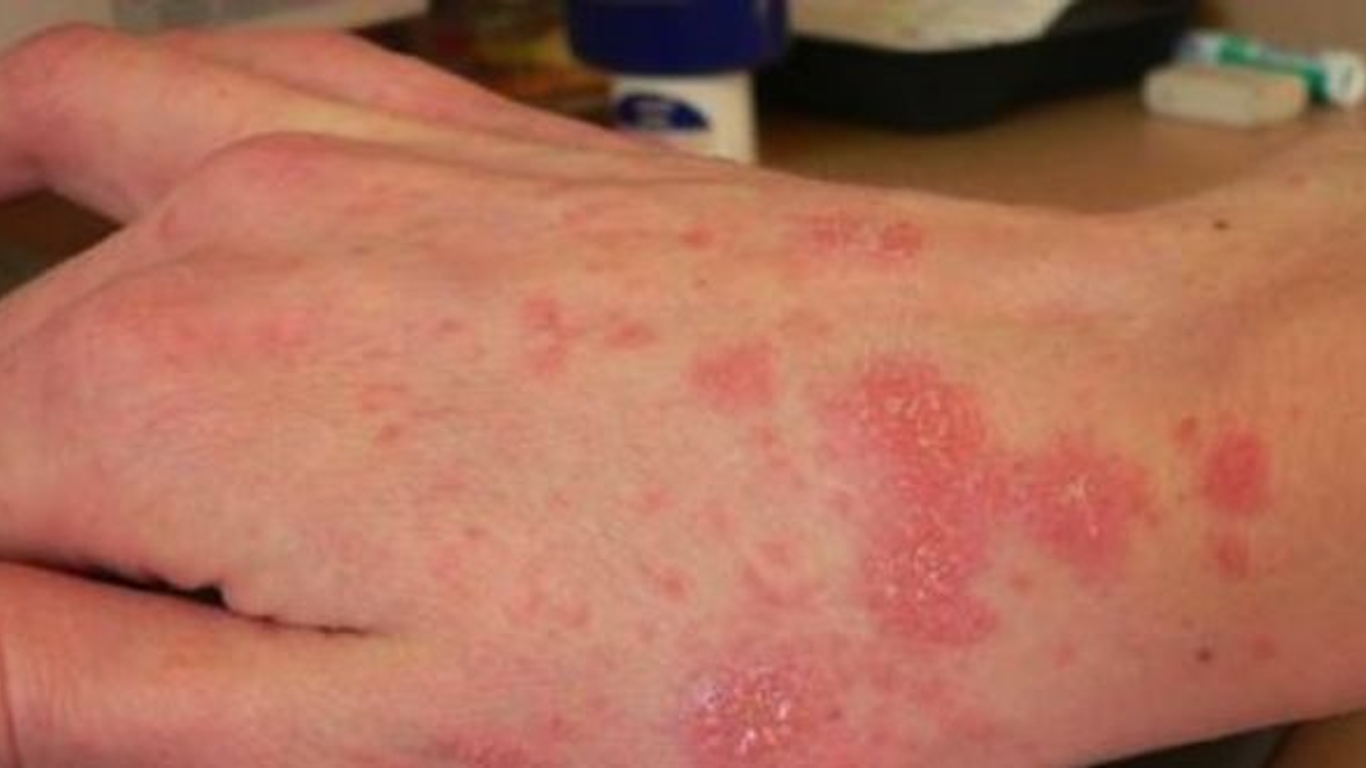 pourquoi la gale est elle une menace serieuse 